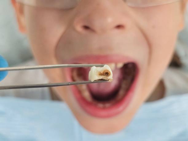 Best Emergency Tooth Extraction in New Knoxville, OH